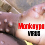 Monkeypox