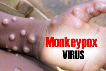 Monkeypox